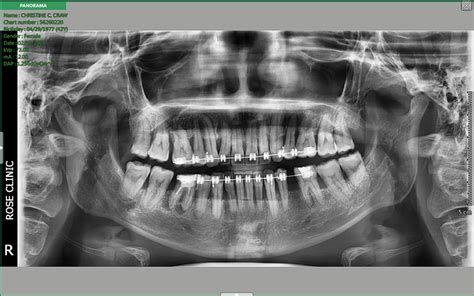 failed braces result|Bracket Failure in Orthodontic Patients: The Incidence and the .